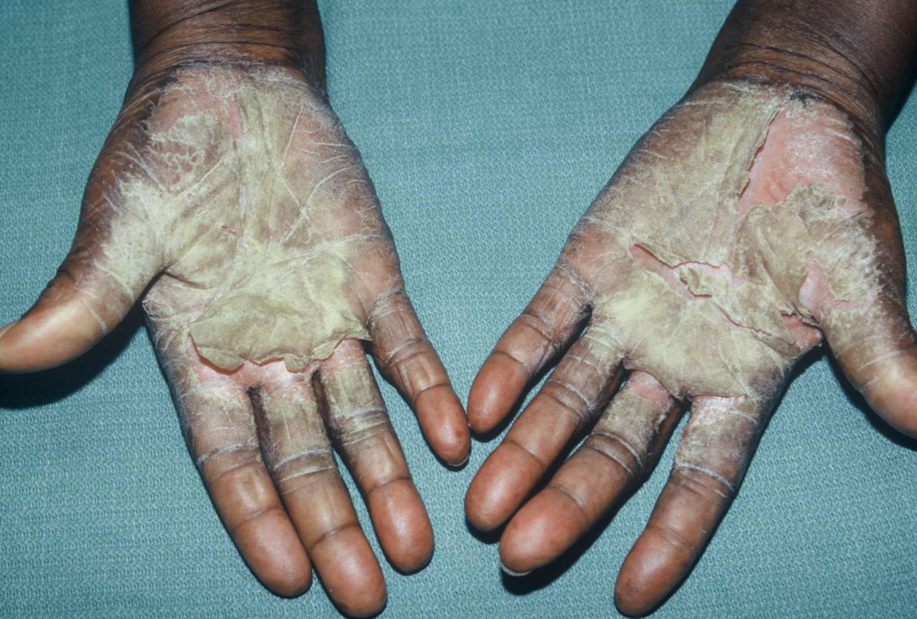 Dyshidrotic Dermatitis On Hands