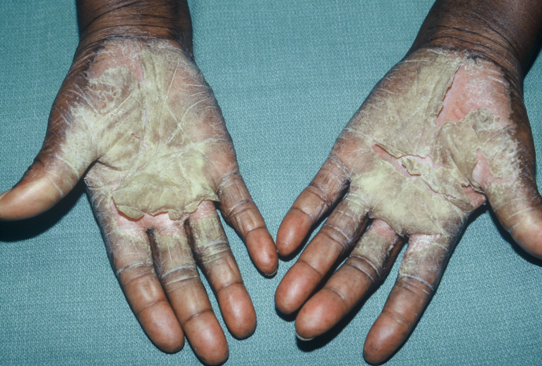 Dyshidrosis India Pdf Ppt Case Reports Symptoms Treatment Dyshidrosis India Pdf Ppt Case Reports Symptoms Treatment