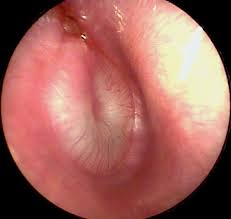 E Coli Infection Poland Pdf Ppt Case Reports Symptoms