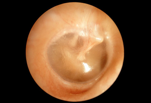 Ear Infection [Otitis Media] | India| PDF | PPT| Case Reports