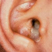 Opinion Otitis media in adults treatment Sorry, Otitis media in adults treatment same