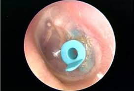 Ear Infection [Otitis Media]