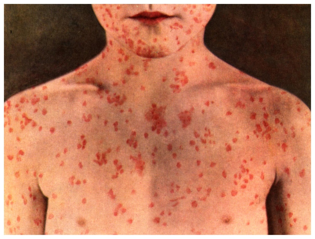 ebola virus disease india