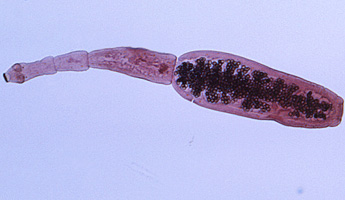 Echinococcosis