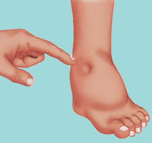 Edema Brazil Pdf Ppt Case Reports Symptoms Treatment Edema Brazil Pdf Ppt Case Reports Symptoms Treatment