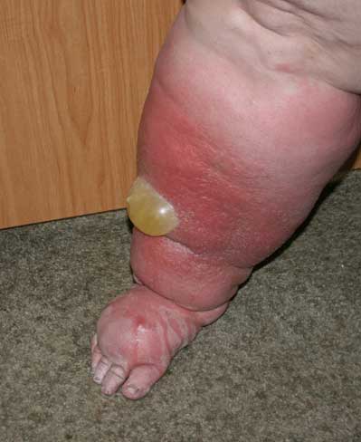 Edema Brazil Pdf Ppt Case Reports Symptoms Treatment Edema Brazil Pdf Ppt Case Reports Symptoms Treatment