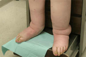 Edema | India| PDF | PPT| Case Reports | Symptoms | Treatment