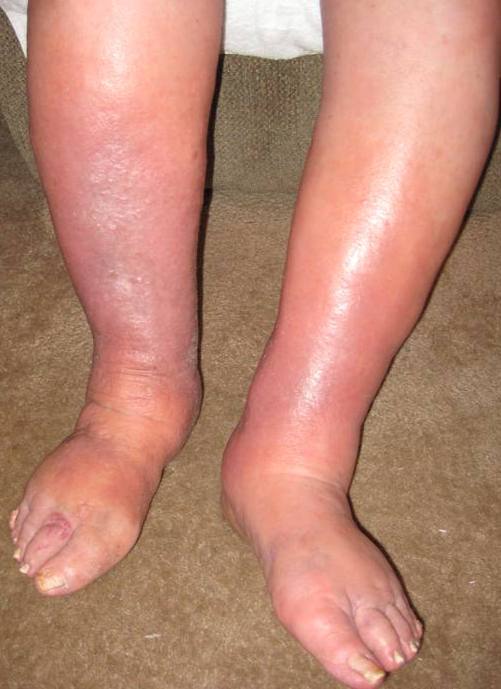 edema ireland pdf ppt case reports symptoms treatment