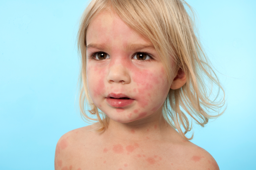 Symptomen en behandeling van ei-allergie