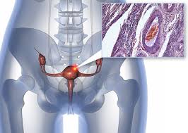 Endometrial cancer