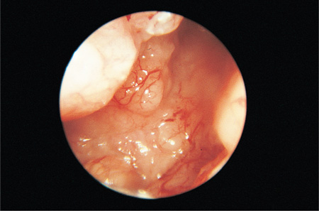 endometrial cancer research paper