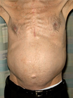 spleen enlarged rib