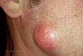 Epidermoid (sebaceous) cysts
