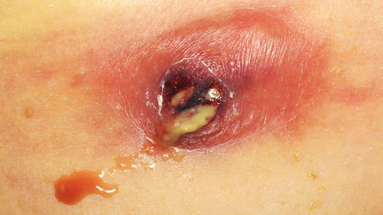 Epidermoid Cyst in Adults: Condition, Treatments, and ...