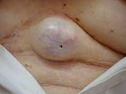 sebaceous cyst rupture epidermoid sebaceous cysts brazil pdf ppt reports symptoms treatment sebaceous cyst rupture epidermoid sebaceous cysts brazil pdf ppt reports symptoms treatment