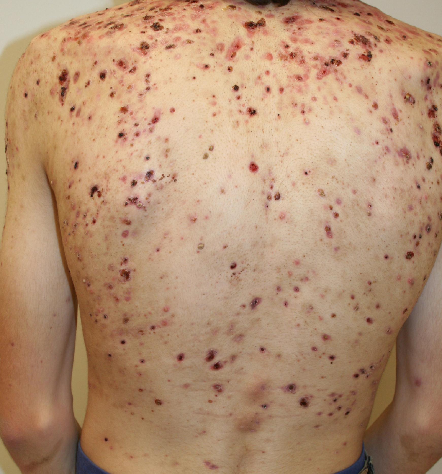 epidermoid sebaceous cysts brazil