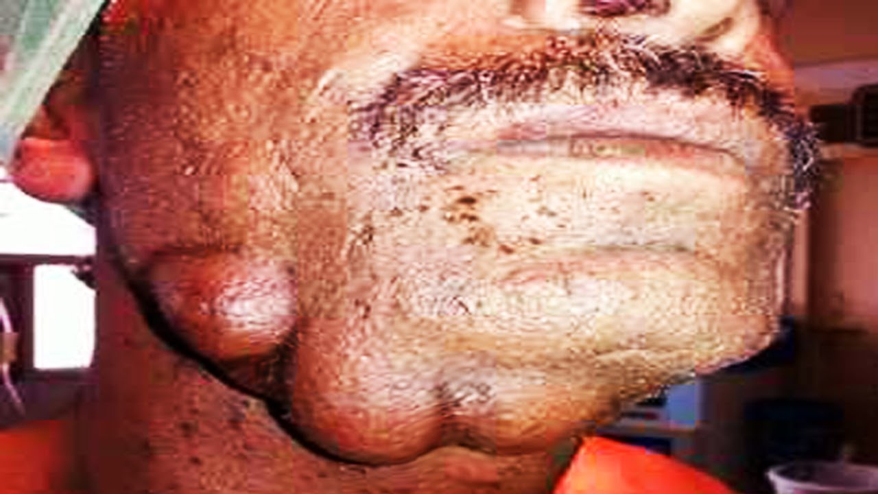 Adult clip masturbation Pictures of epidermoid facial cysts