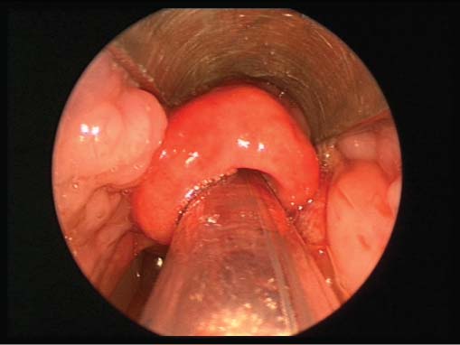 Haemophilus Influenzae Type B (Hib)