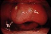Epiglottitis