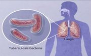 Extensively Drug Resistant TB