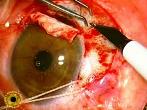 Eye melanoma