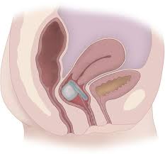 Fecal incontinence
