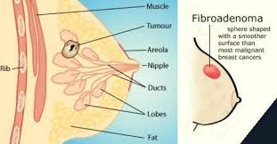 Excellent answer cell salts breast fiberous disease above Cell salts breast fiberous disease topic