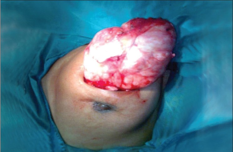 fibroadenoma of breast