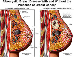 Fibrocystic breasts
