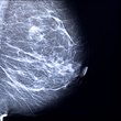 Fibrocystic breasts