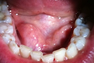 Floor of the Mouth Cancer