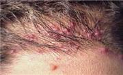Folliculitis | Mexico|...