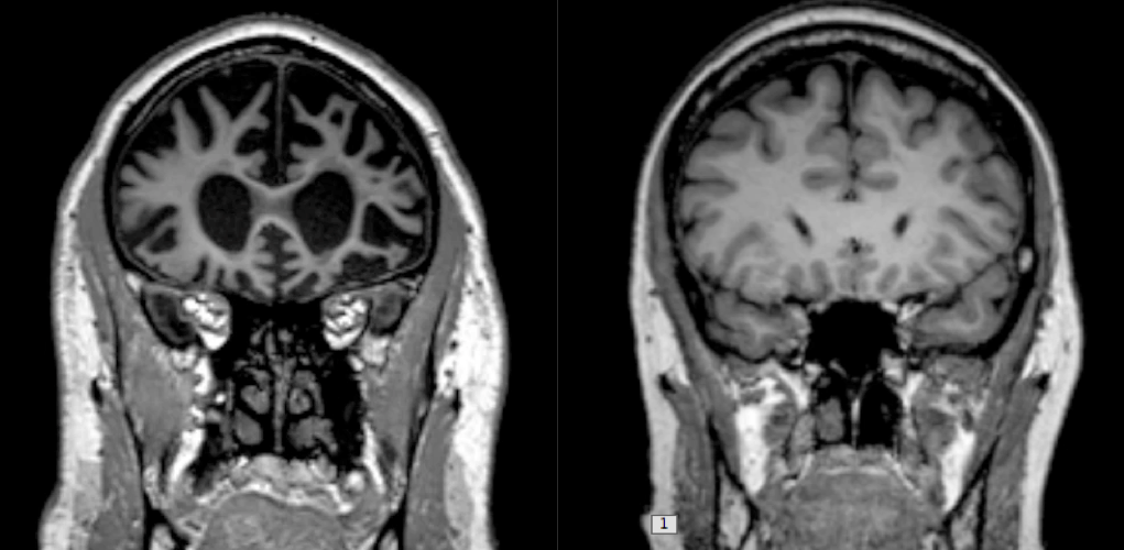 Frontotemporal dementia Norway PDF PPT Case Reports Symptoms