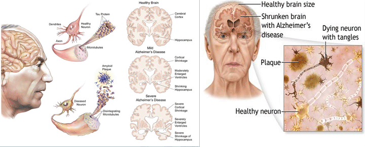 Frontotemporal dementia | Ireland| PDF | PPT| Case Reports | Symptoms