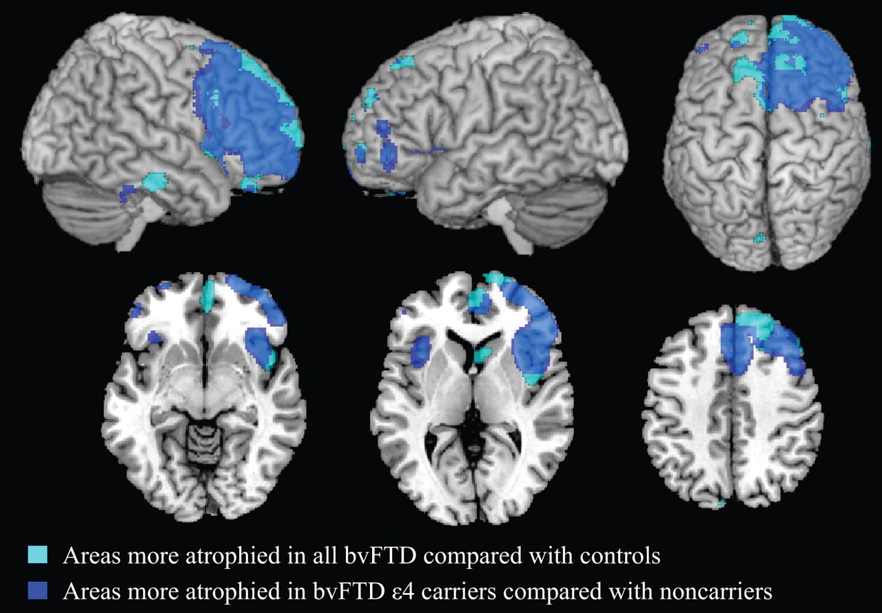 Frontotemporal Dementias