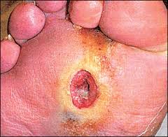 fungal diseases australia pdf ppt case reports symptoms