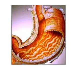 Gastritis