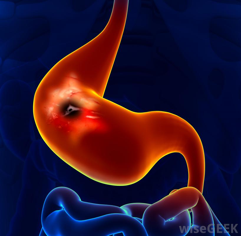 Gastritis