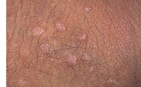 Mild genital herpes