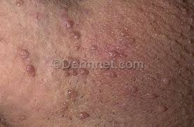 genital warts in the vagina Genital warts in the vagina