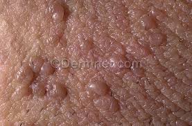 picture of wart on the vagina Valentina smirnova nude