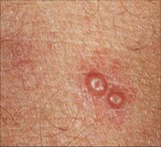 photo of vaginal warts Photo of vaginal warts