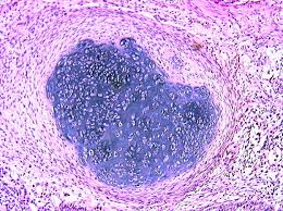 Germ Cell Tumors