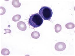 hairy cell leukamia Flack black sluts