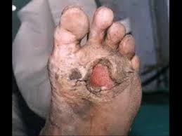 Hansens disease (HD)/ Leprosy | Belgium| PDF | PPT| Case