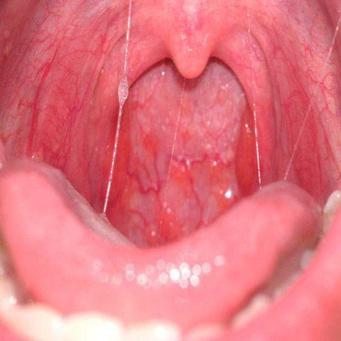 throat cancer Sperm throat cancer Sperm