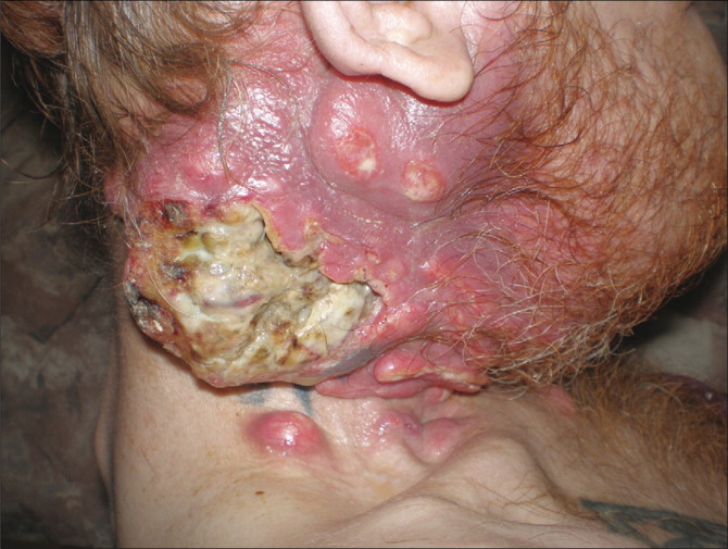 Genital Herpes - HSV-1 & 2 - WebMD: Symptoms, Treatments ...