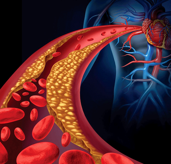 Heart disease