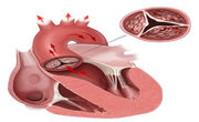 Heart Valve Disease