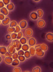 hematuria articles